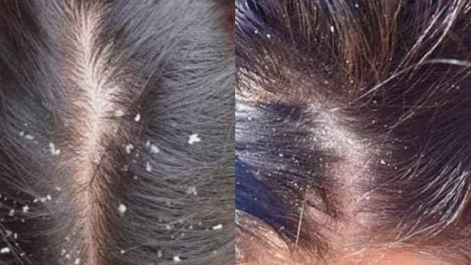 Dont Ignore Dandruff In Winters