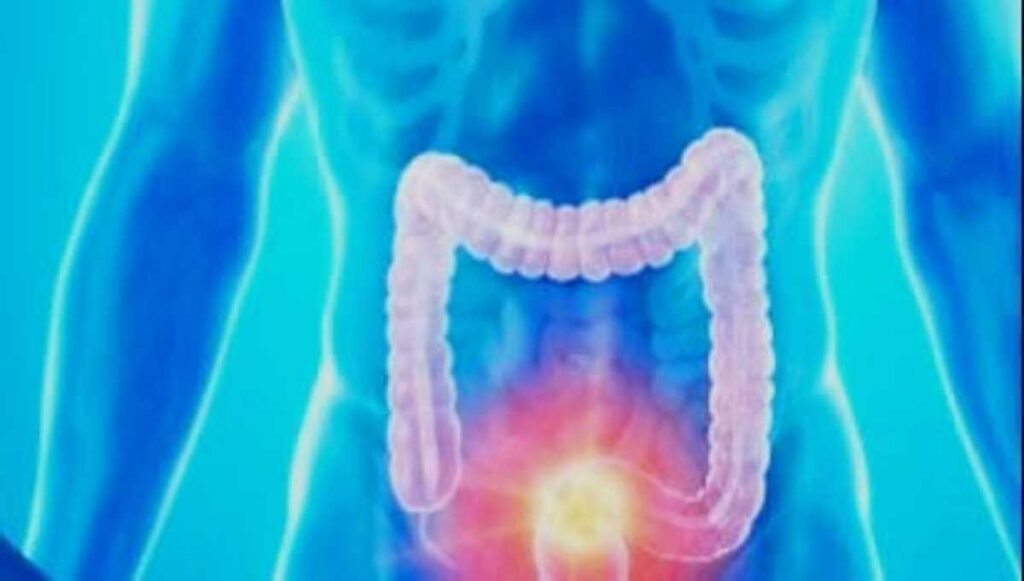 Colon Cancer