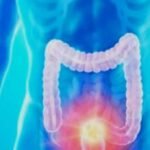 Colon Cancer