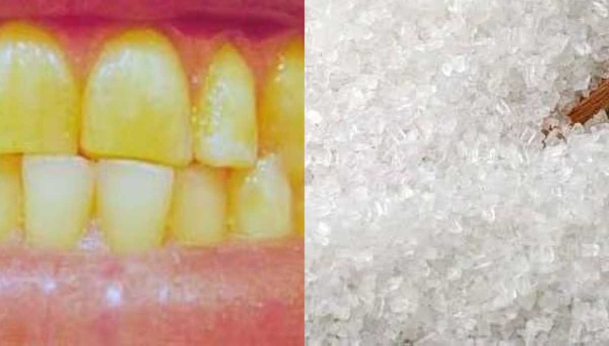 ज्यादा चीनी खाने से क्यों होते हैं दांत पीले? जानिए शरीर पर इसके गंभीर असर 1 चीनी